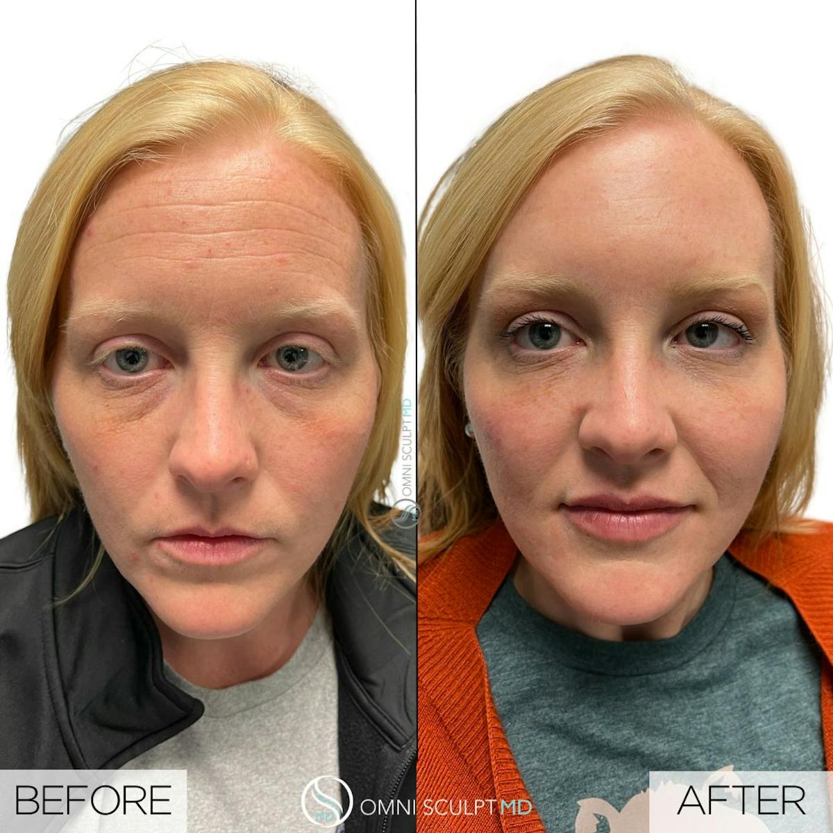 Full Facial Rejuvenation Before & After Gallery - Patient 293353 - Image 1