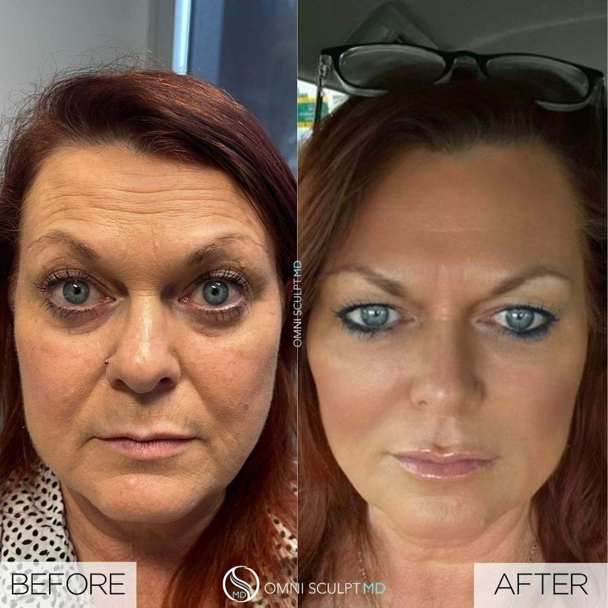Full Facial Rejuvenation Before & After Gallery - Patient 209444 - Image 1