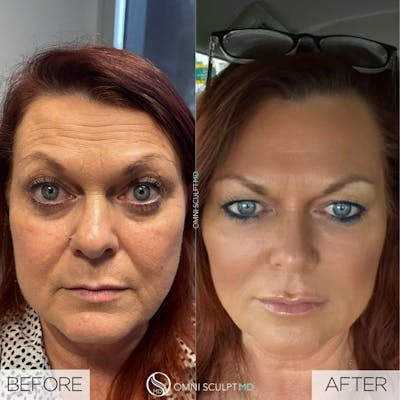 Full Facial Rejuvenation Before & After Gallery - Patient 209444 - Image 1
