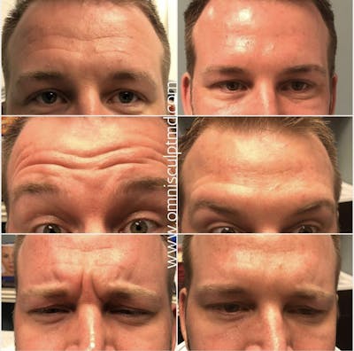 Botox/Neuromodulators Before & After Gallery - Patient 406325 - Image 1