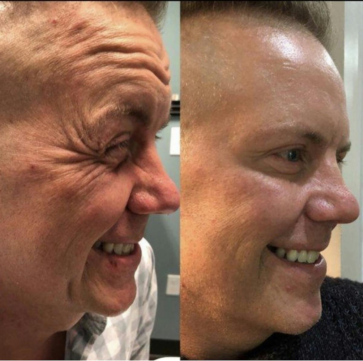 Botox/Neuromodulators Before & After Gallery - Patient 862167 - Image 2