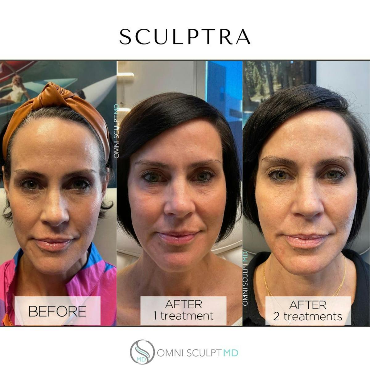 Sculptra Before & After Gallery - Patient 329751 - Image 1