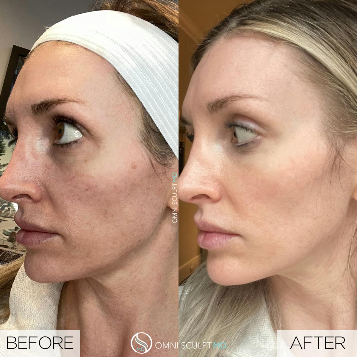 Helix CO2 Laser Before & After Gallery - Patient 351722 - Image 3