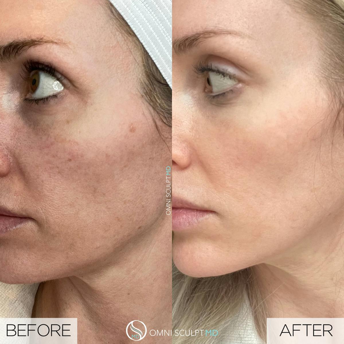Helix CO2 Laser Before & After Gallery - Patient 351722 - Image 4