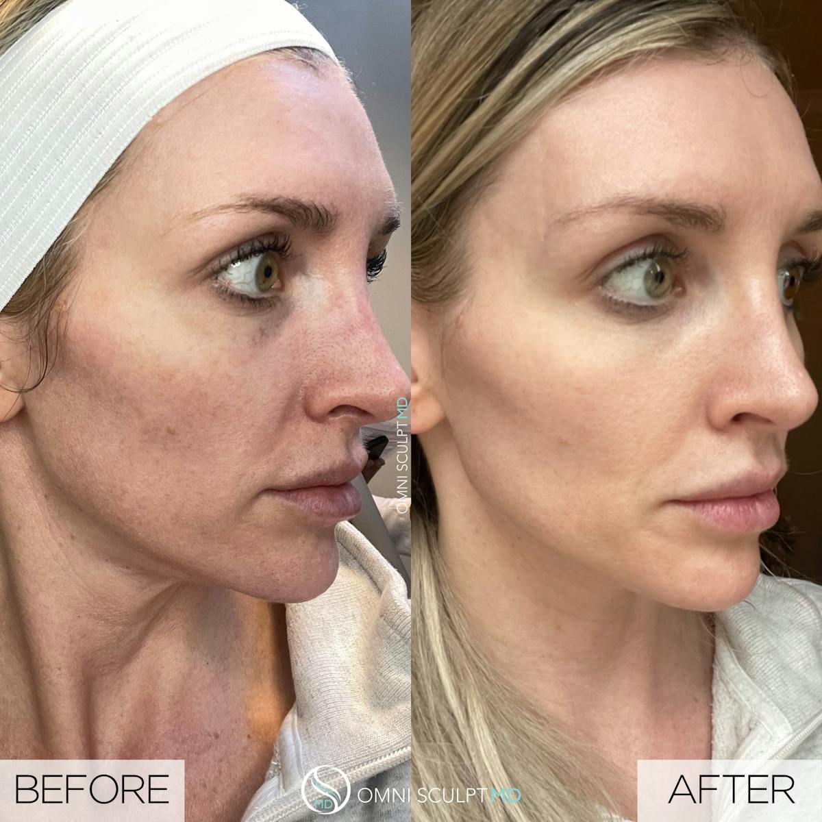 Helix CO2 Laser Before & After Gallery - Patient 351722 - Image 1