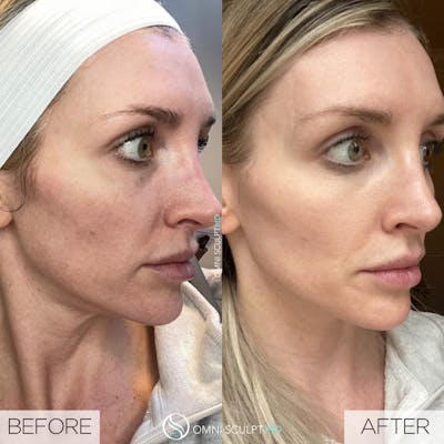 Helix CO2 Laser Before & After Gallery - Patient 351722 - Image 1
