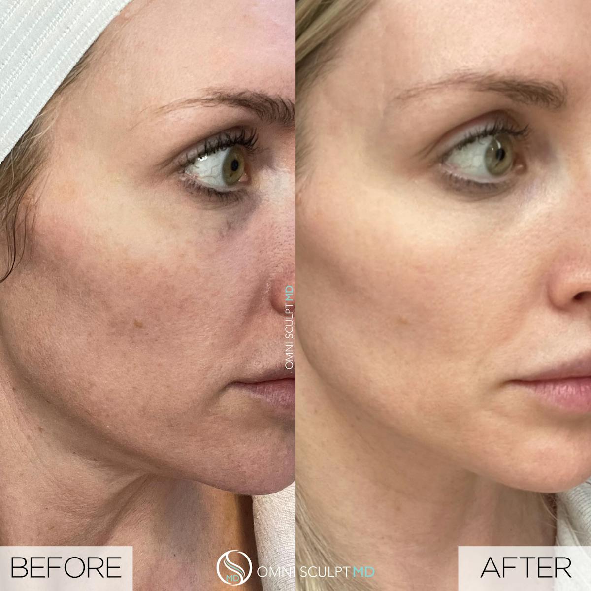 Helix CO2 Laser Before & After Gallery - Patient 351722 - Image 2
