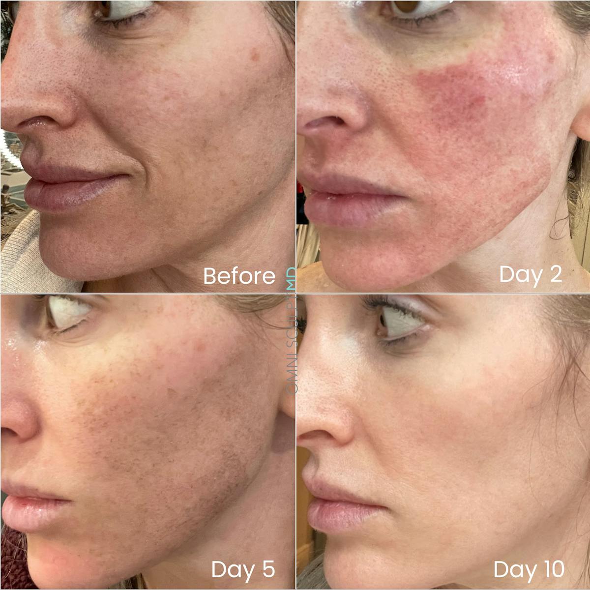 Helix CO2 Laser Before & After Gallery - Patient 351722 - Image 5