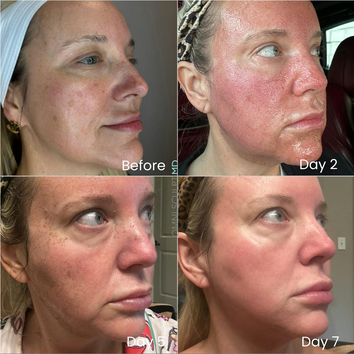 Helix CO2 Laser Before & After Gallery - Patient 191948 - Image 3