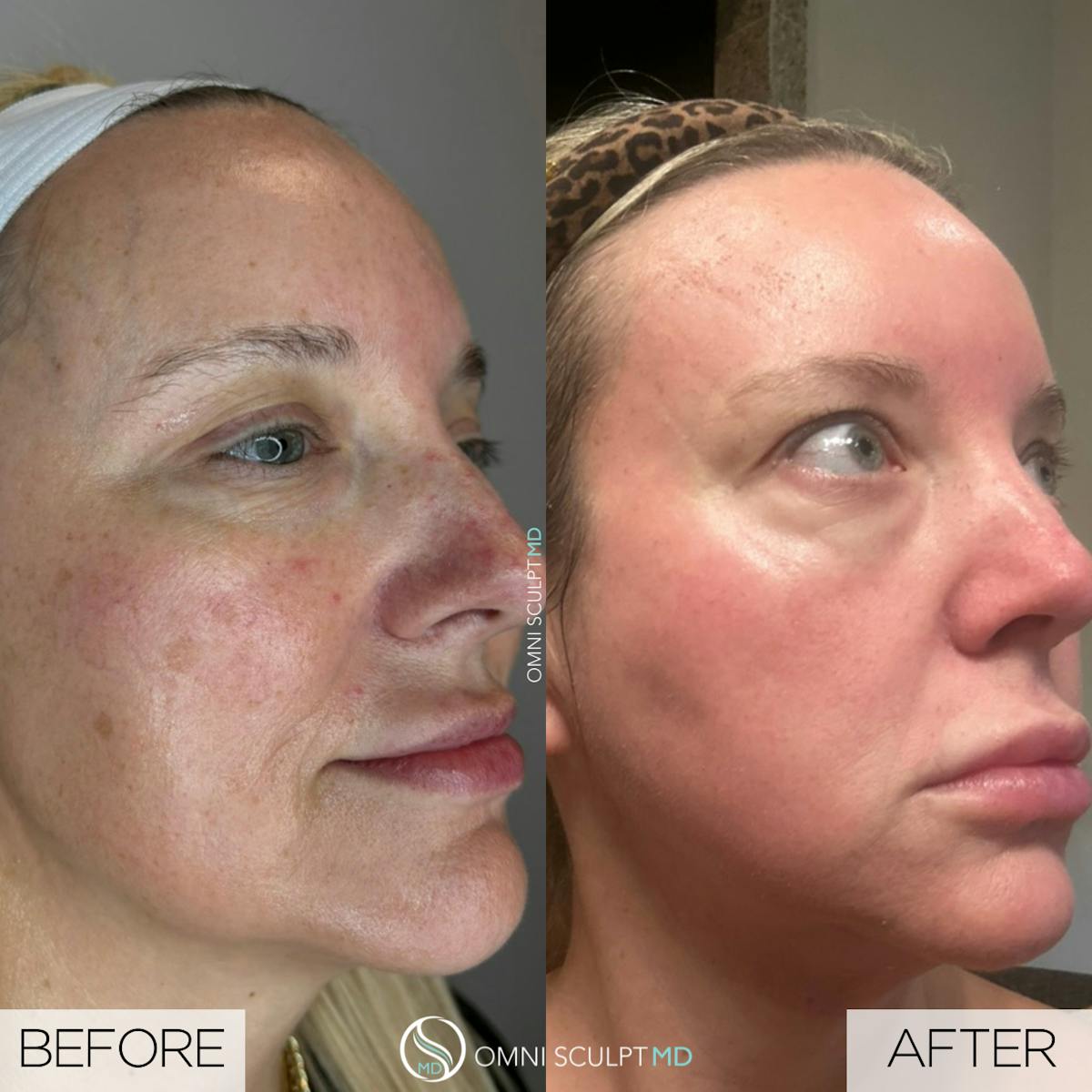 Helix CO2 Laser Before & After Gallery - Patient 191948 - Image 2