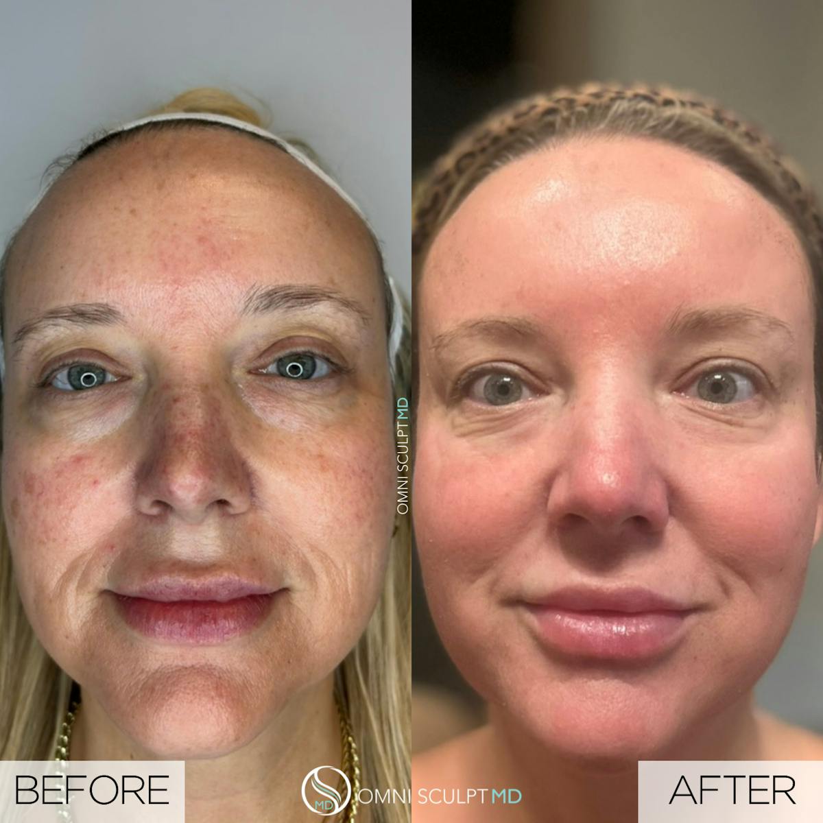 Helix CO2 Laser Before & After Gallery - Patient 191948 - Image 1
