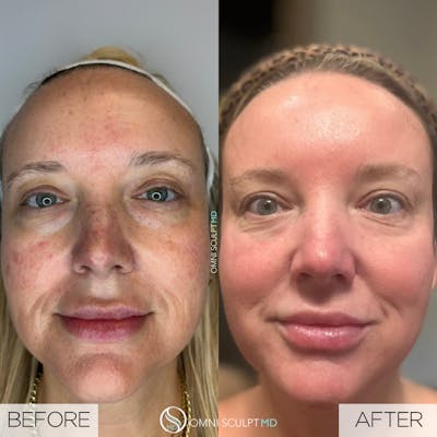 Helix CO2 Laser Before & After Gallery - Patient 191948 - Image 1