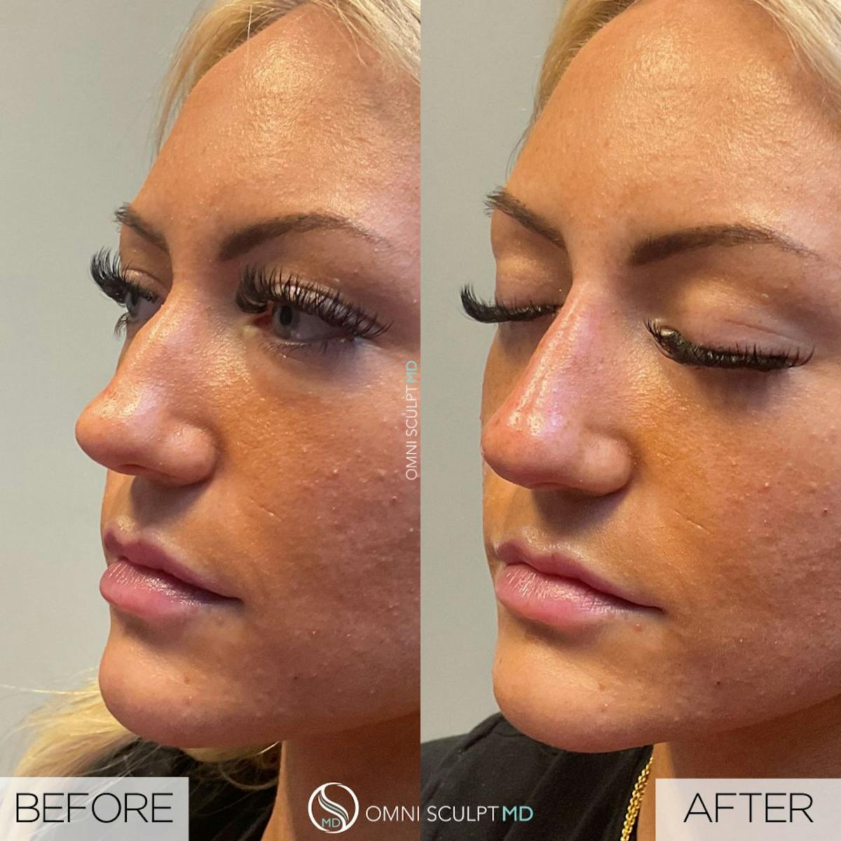 Nose Filler Before & After Gallery - Patient 175347 - Image 1