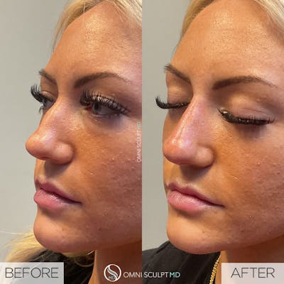 Nose Filler Before & After Gallery - Patient 175347 - Image 1