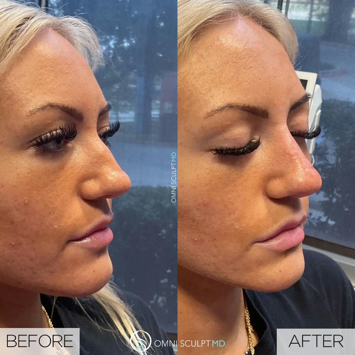 Nose Filler Before & After Gallery - Patient 175347 - Image 2