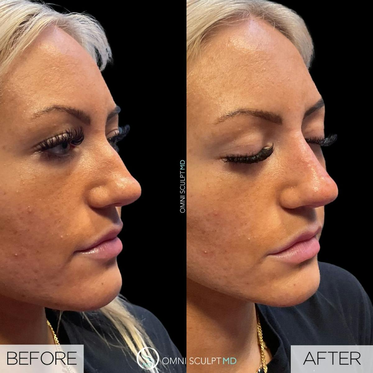 Nose Filler Before & After Gallery - Patient 175347 - Image 3
