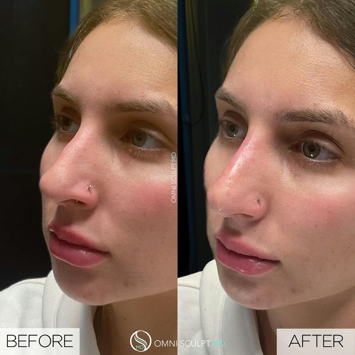 Nose Filler Before & After Gallery - Patient 302071 - Image 2