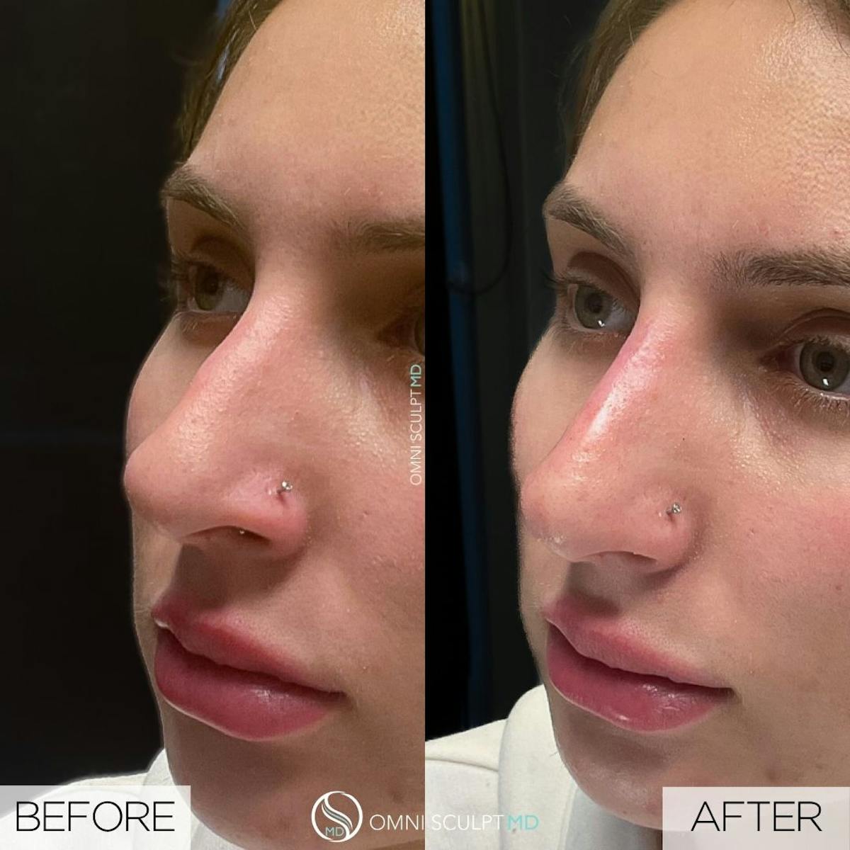 Nose Filler Before & After Gallery - Patient 302071 - Image 3