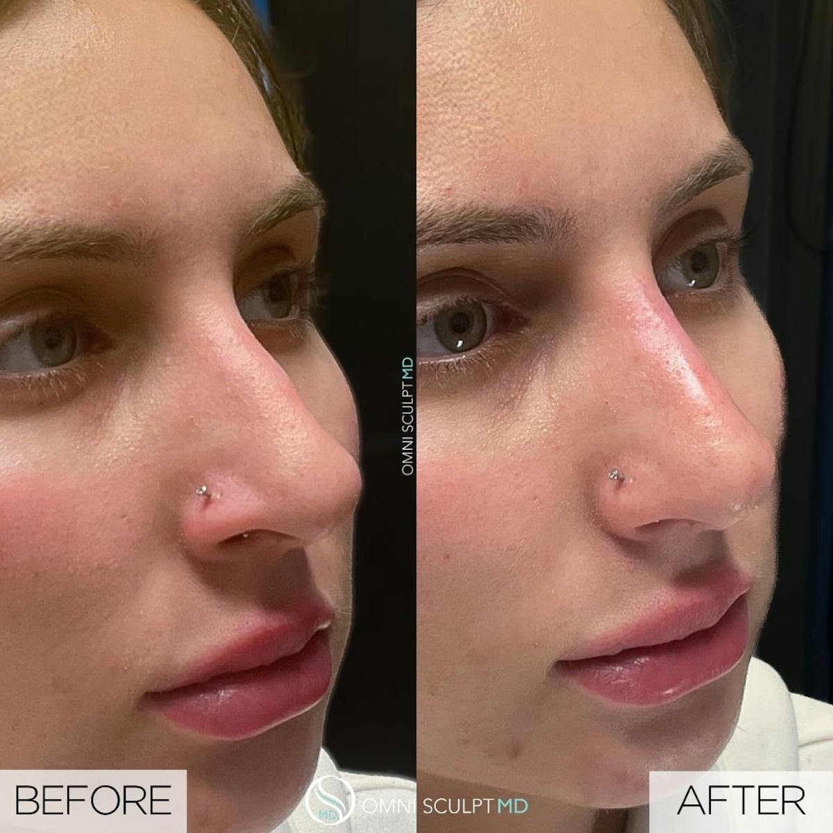 Nose Filler Before & After Gallery - Patient 302071 - Image 1