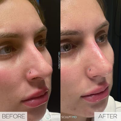 Nose Filler Before & After Gallery - Patient 302071 - Image 1