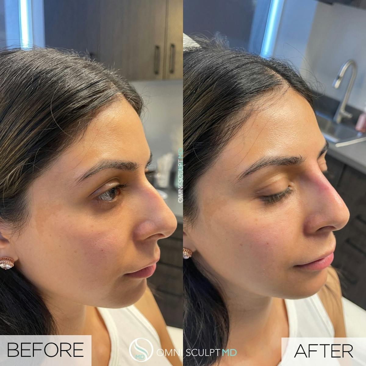 Nose Filler Before & After Gallery - Patient 756228 - Image 1