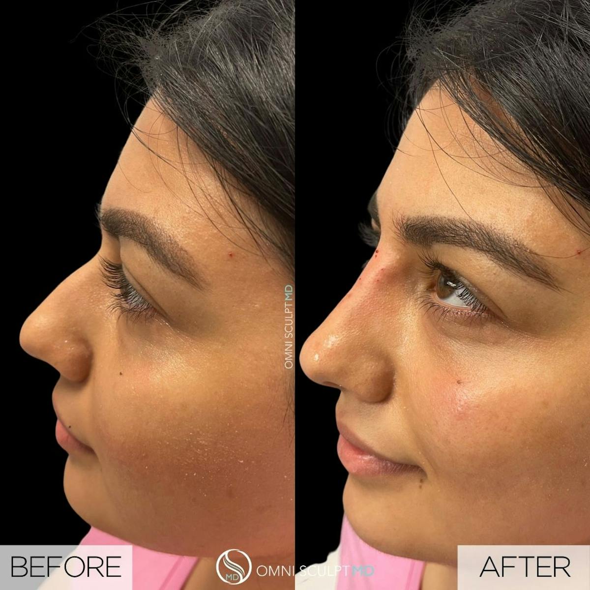 Nose Filler Before & After Gallery - Patient 215312 - Image 3