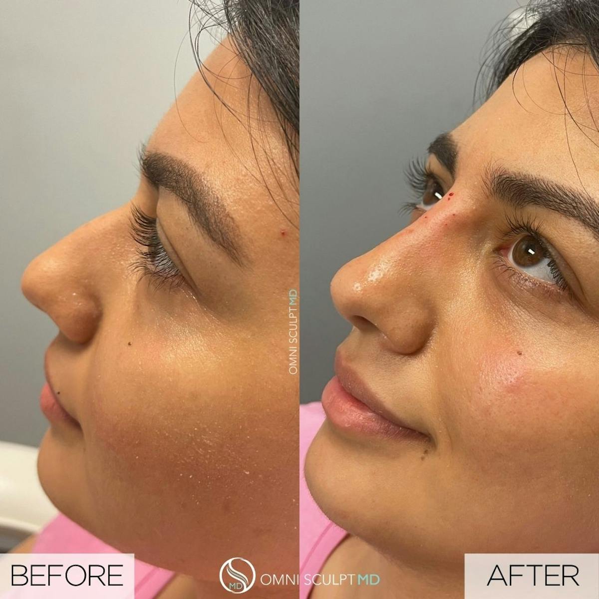 Nose Filler Before & After Gallery - Patient 215312 - Image 2