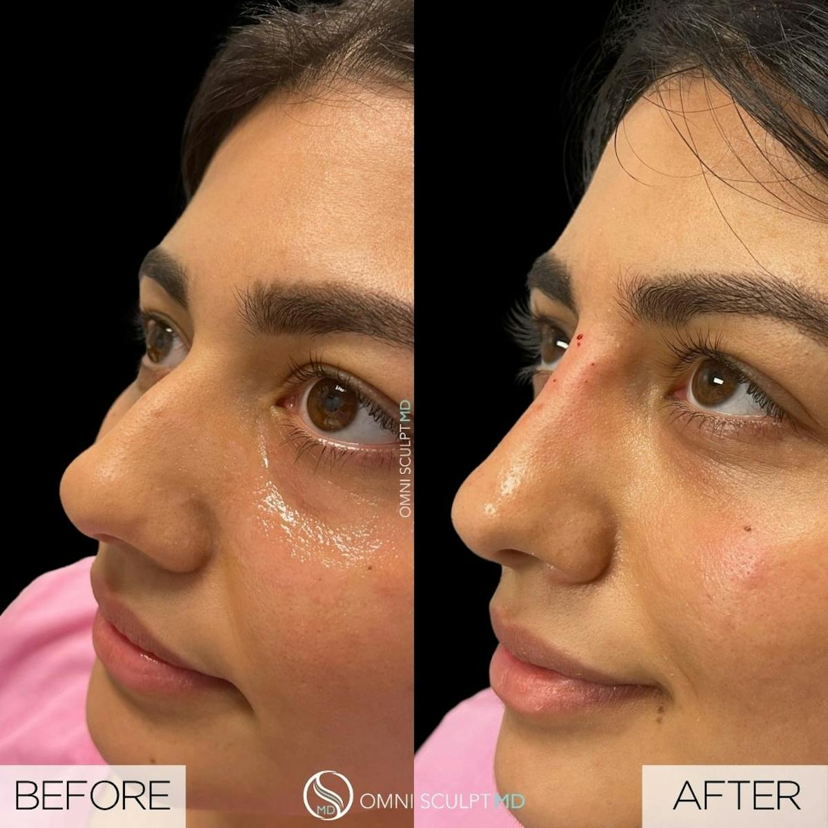 Nose Filler Before & After Gallery - Patient 215312 - Image 1