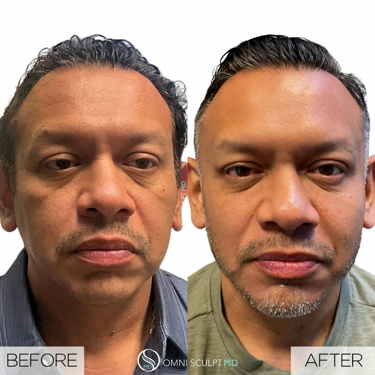 Full Facial Rejuvenation Before & After Gallery - Patient 458748 - Image 1