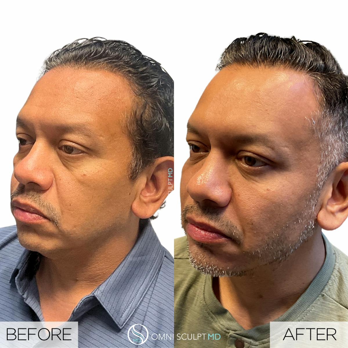 Full Facial Rejuvenation Before & After Gallery - Patient 458748 - Image 3