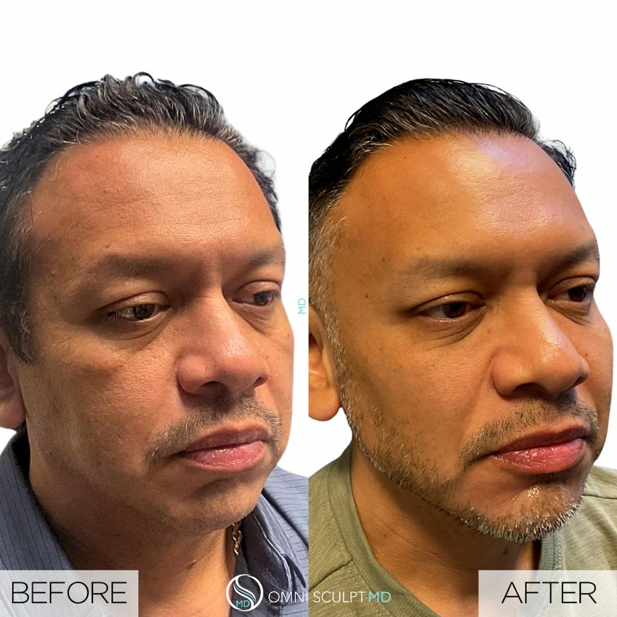 Full Facial Rejuvenation Before & After Gallery - Patient 458748 - Image 2