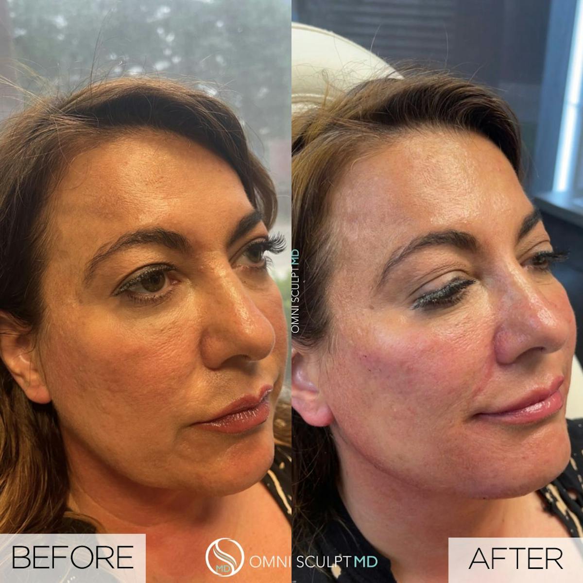Full Facial Rejuvenation Before & After Gallery - Patient 175614 - Image 1