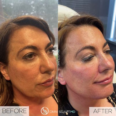 Full Facial Rejuvenation Before & After Gallery - Patient 175614 - Image 1