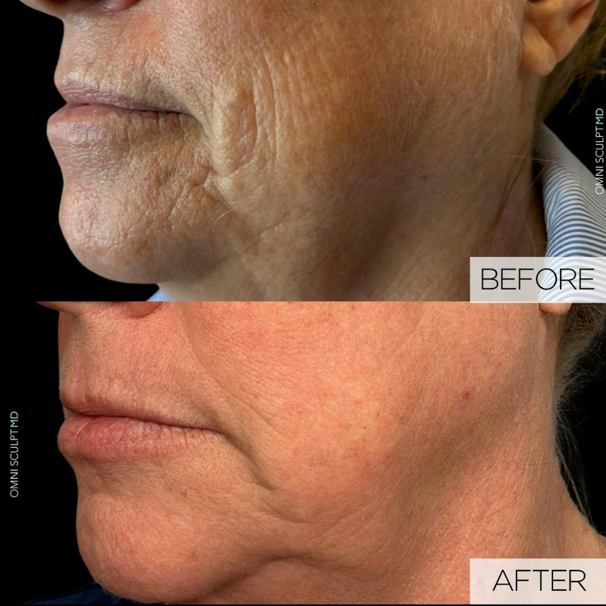 Helix CO2 Laser Before & After Gallery - Patient 278011 - Image 2
