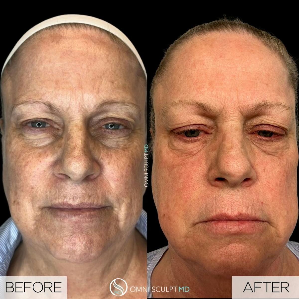 Helix CO2 Laser Before & After Gallery - Patient 278011 - Image 1