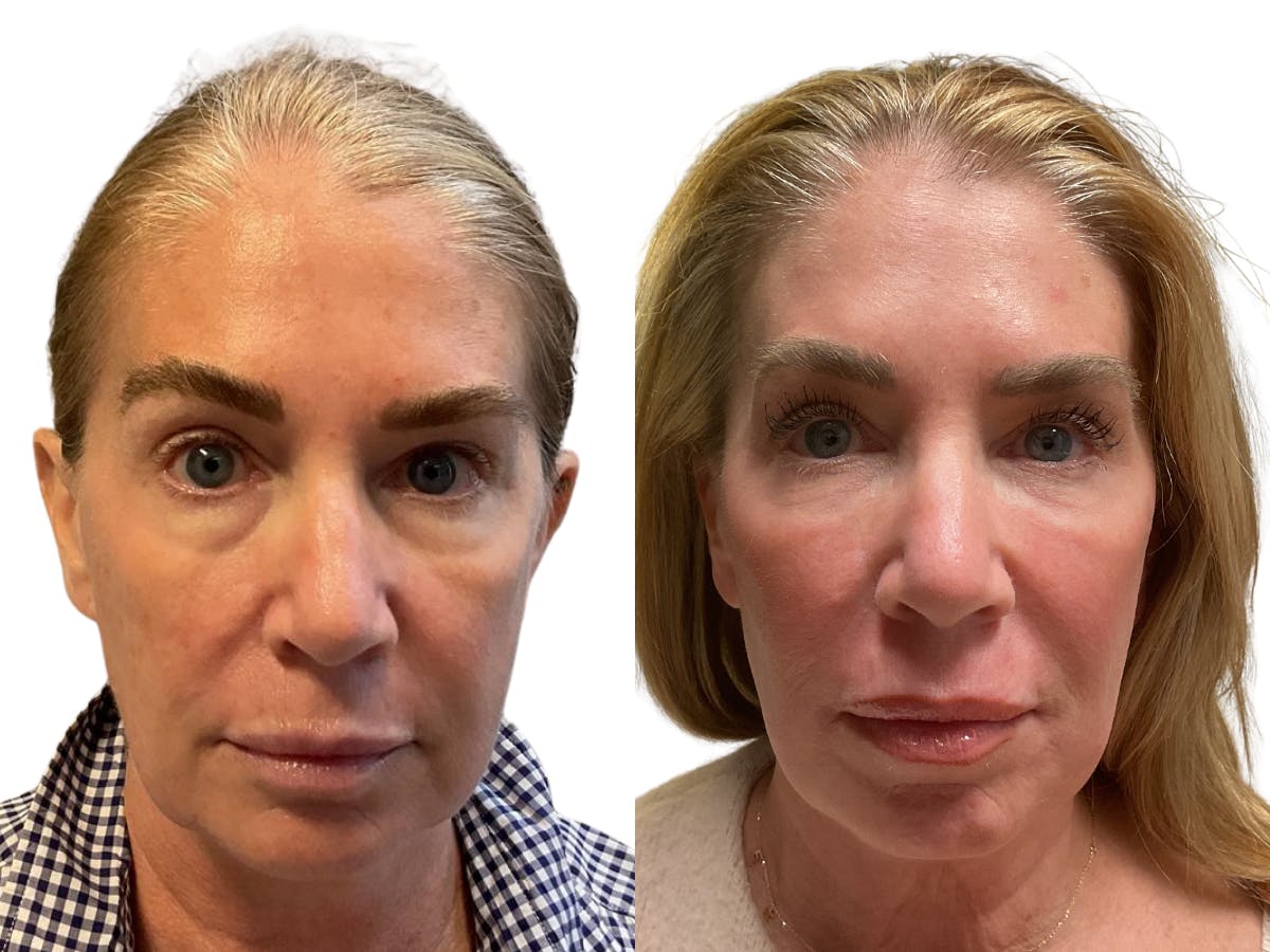 Helix CO2 Laser Before & After Gallery - Patient 406117 - Image 2