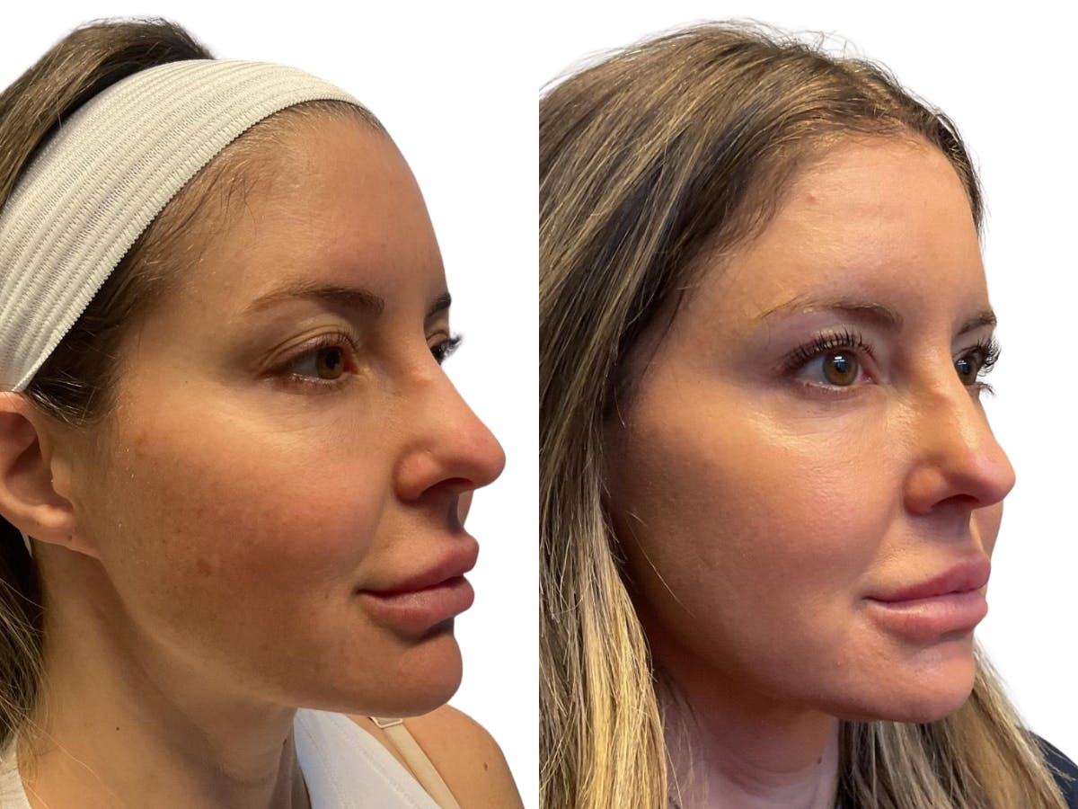 Helix CO2 Laser Before & After Gallery - Patient 161186 - Image 2