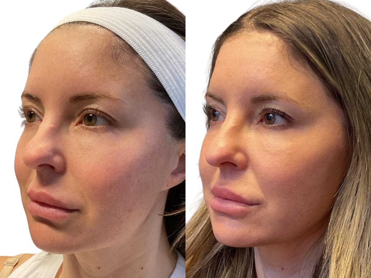 Helix CO2 Laser Before & After Gallery - Patient 161186 - Image 1