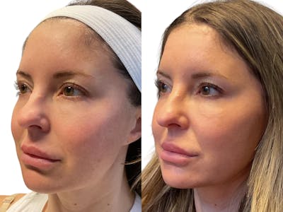 Helix CO2 Laser Before & After Gallery - Patient 161186 - Image 1