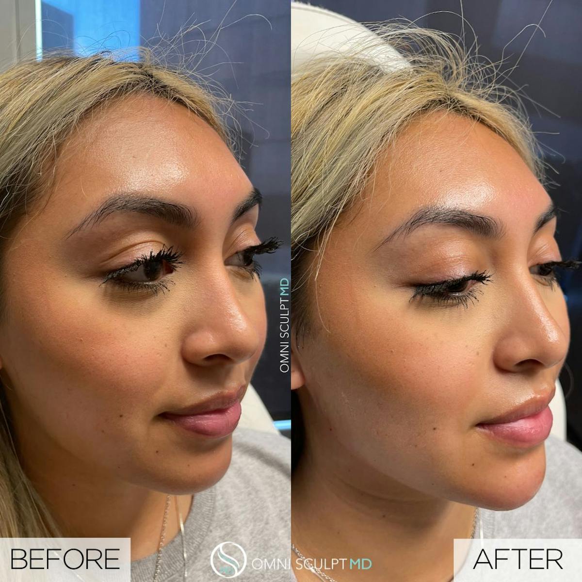 Jawline Chin Filler Before & After Gallery - Patient 188840 - Image 1