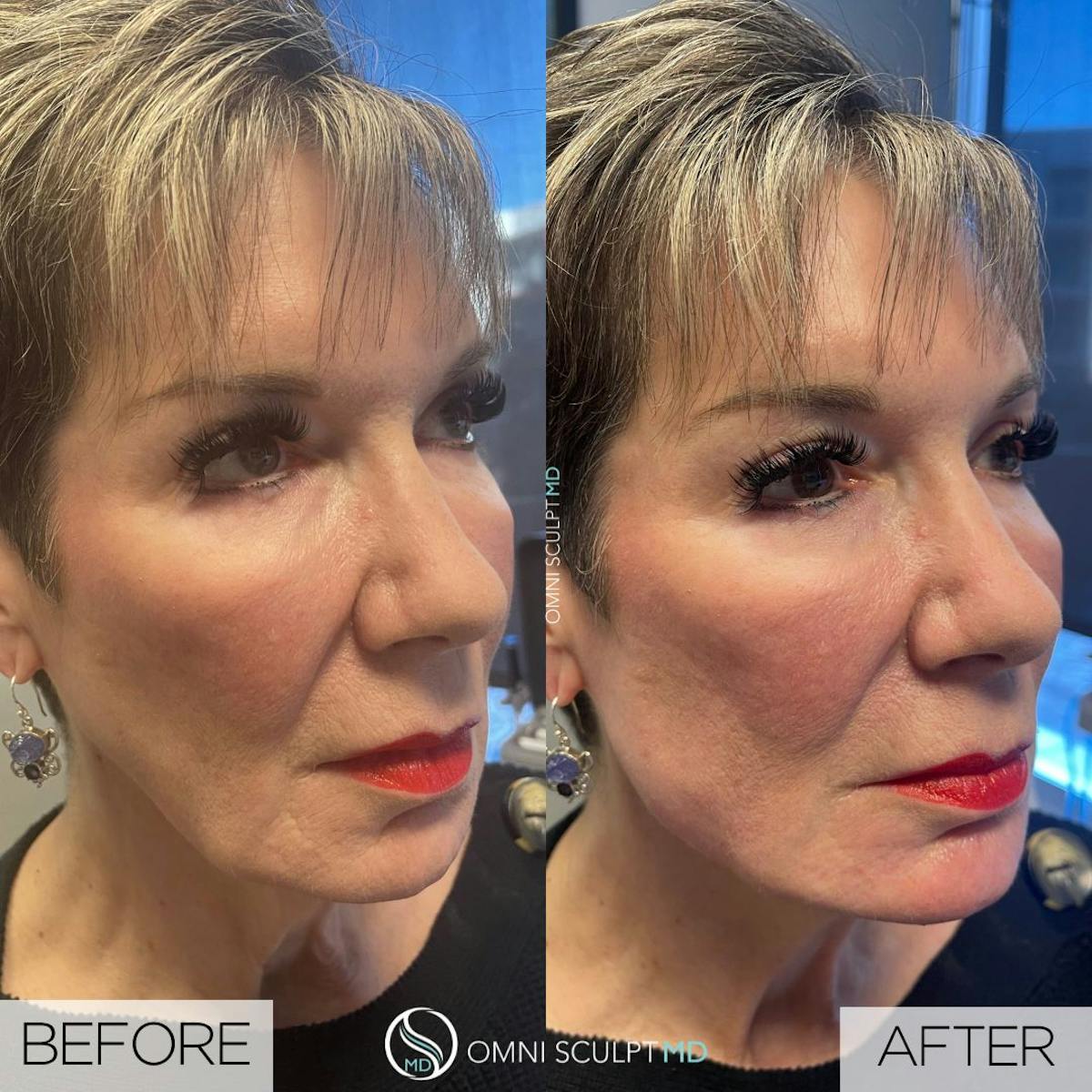 Jawline Chin Filler Before & After Gallery - Patient 105027 - Image 1
