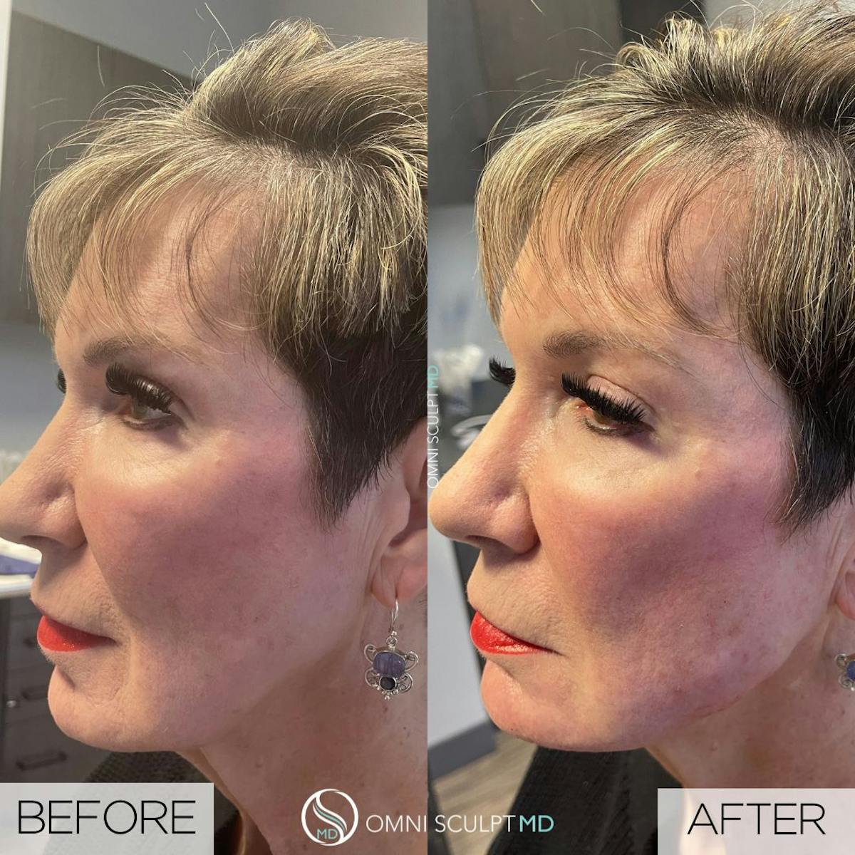 Jawline Chin Filler Before & After Gallery - Patient 105027 - Image 2
