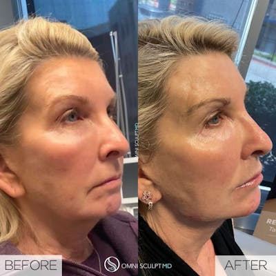 Jawline Chin Filler Before & After Gallery - Patient 340696 - Image 1