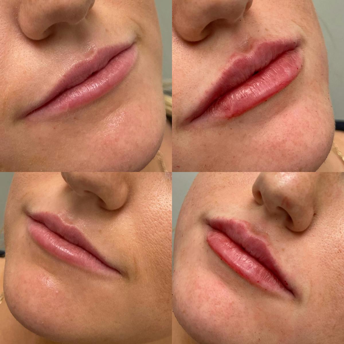 Lips Before & After Gallery - Patient 287590 - Image 1