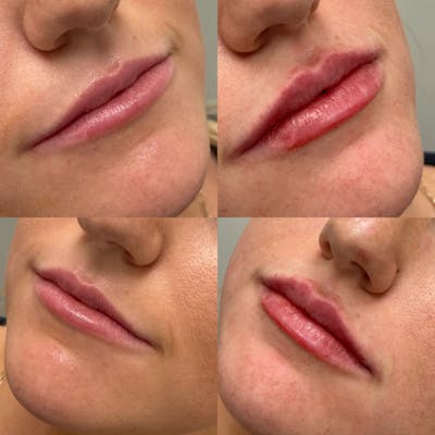 Lips Before & After Gallery - Patient 287590 - Image 1