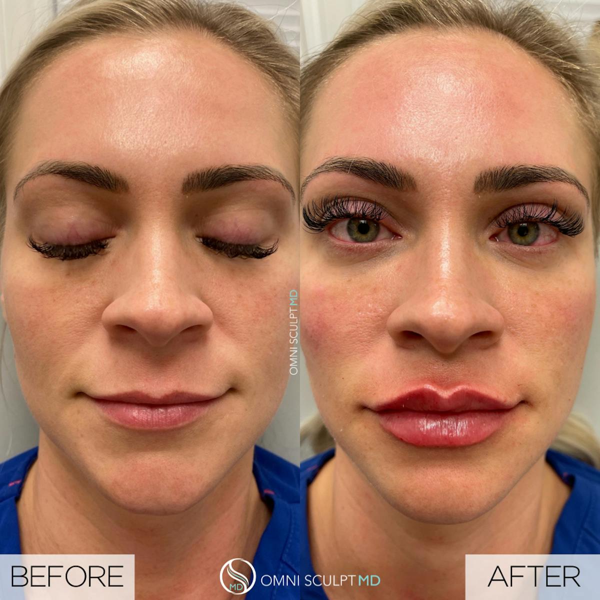 Lips Before & After Gallery - Patient 373481 - Image 1