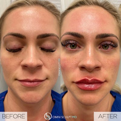 Lips Before & After Gallery - Patient 373481 - Image 1