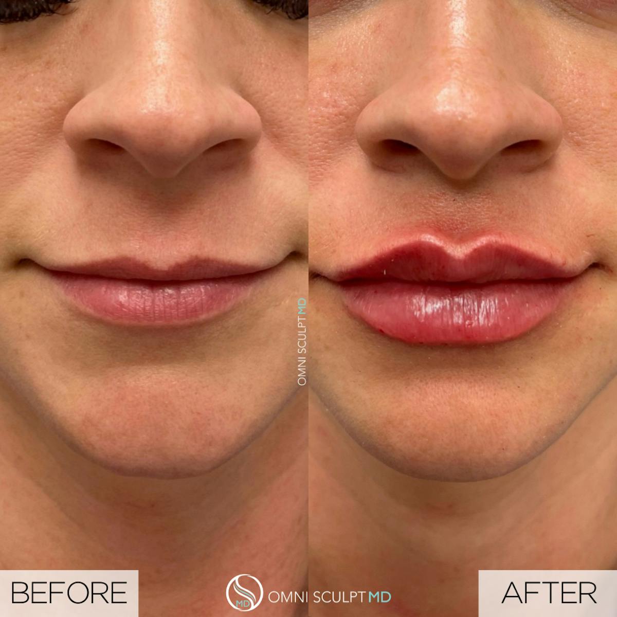 Lips Before & After Gallery - Patient 373481 - Image 2