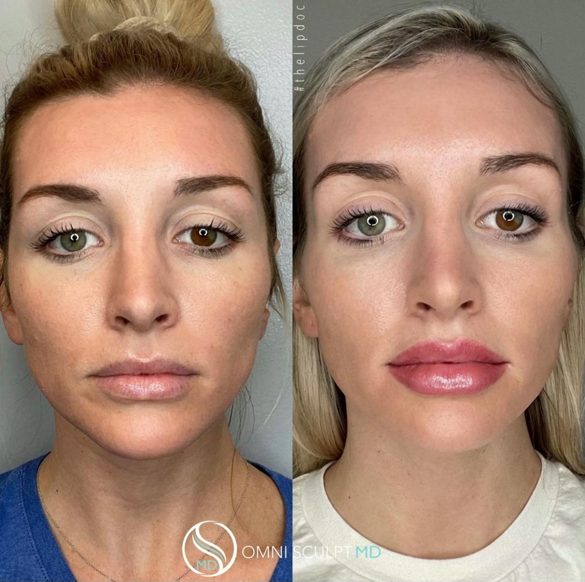Lips Before & After Gallery - Patient 338604 - Image 2