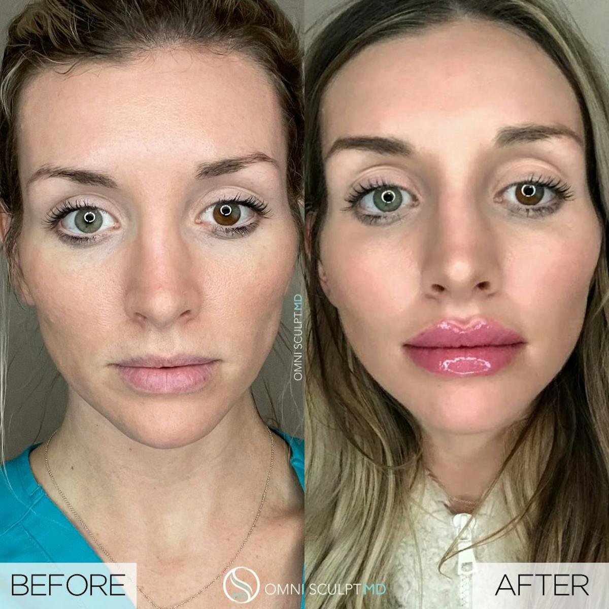 Lips Before & After Gallery - Patient 338604 - Image 1